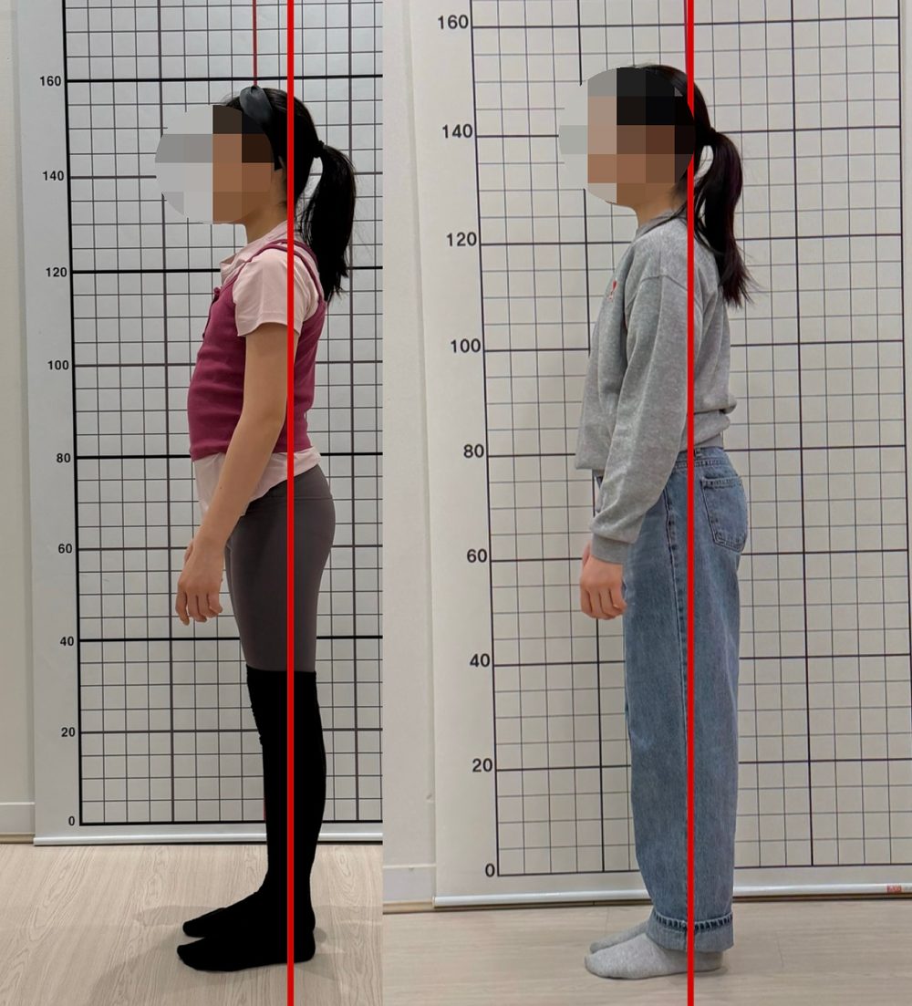 초등학생 회원의 자세 전후 비교