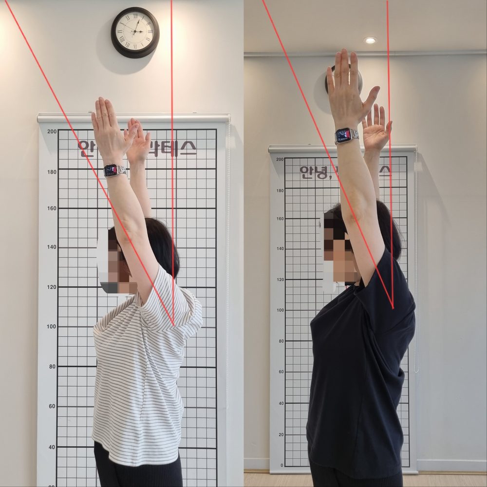 오십견 회원의 팔 올리기 전후 비교